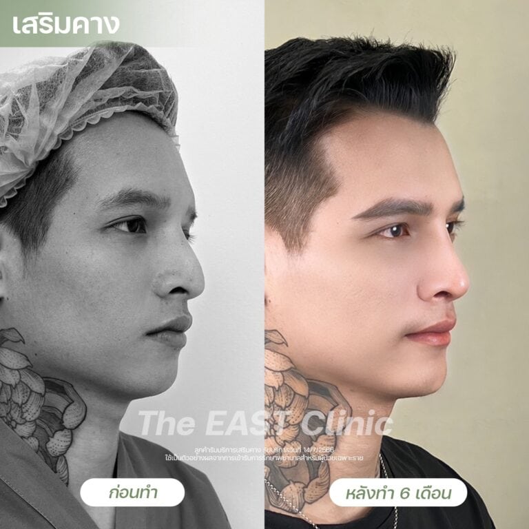 chin-surgery