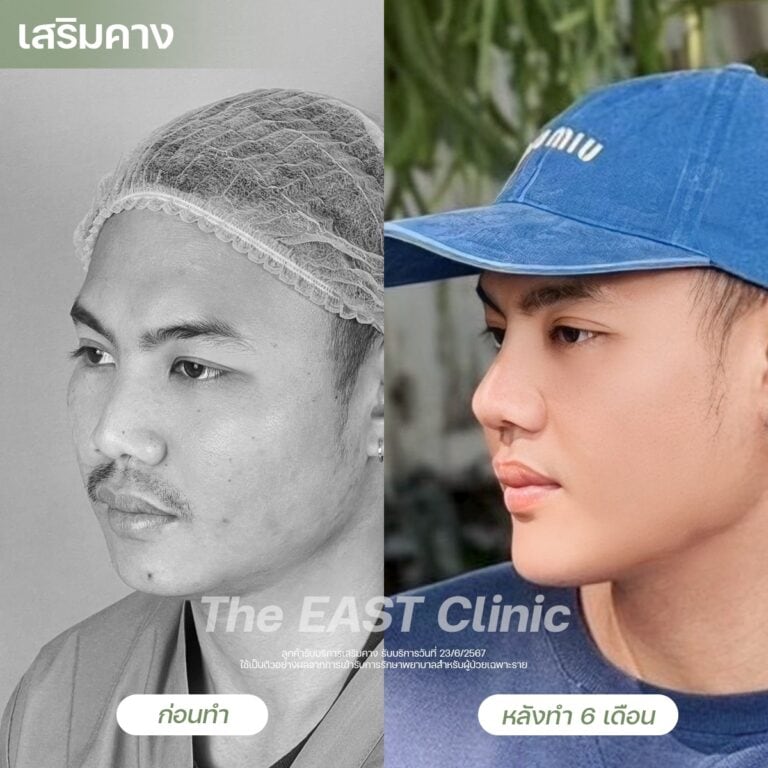 chin-surgery