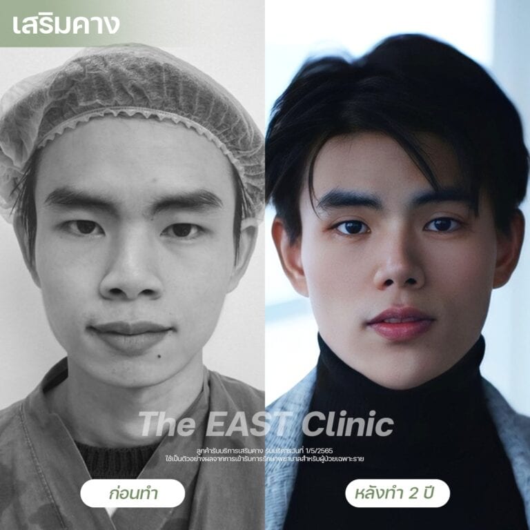 chin-surgery