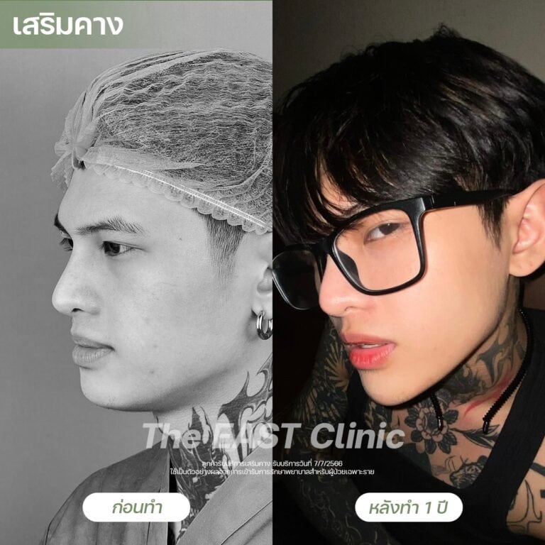 chin-surgery