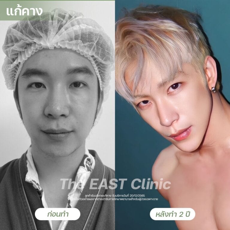 chin-surgery