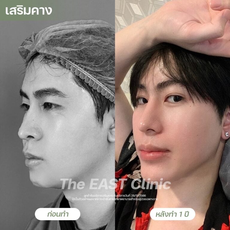 chin-surgery