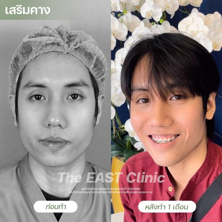 chin-surgery