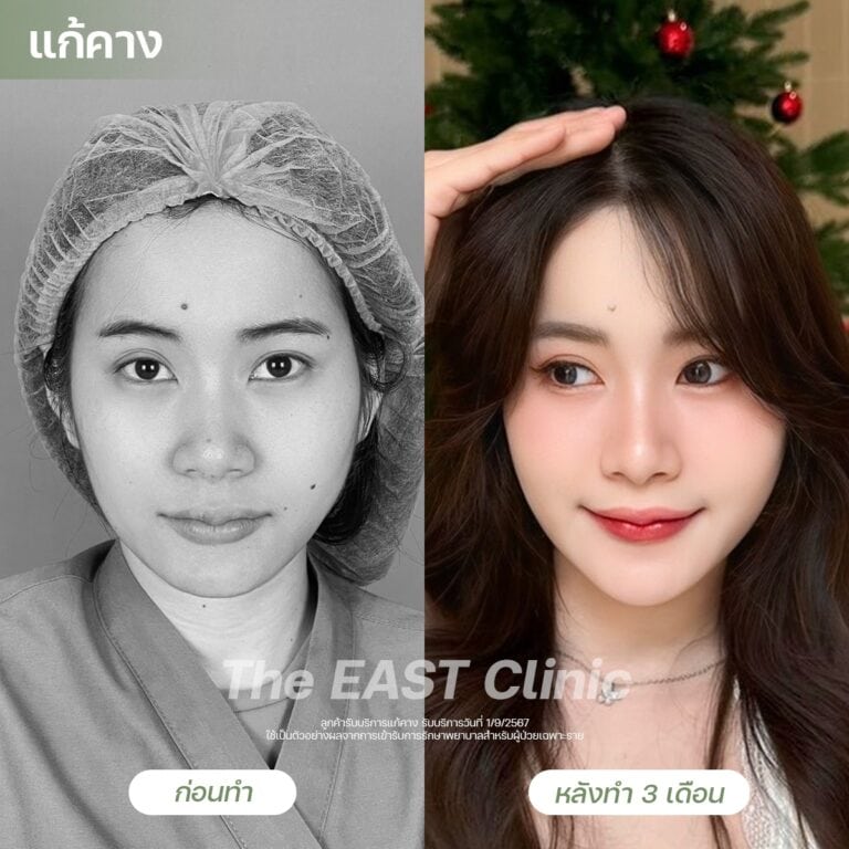 chin-surgery
