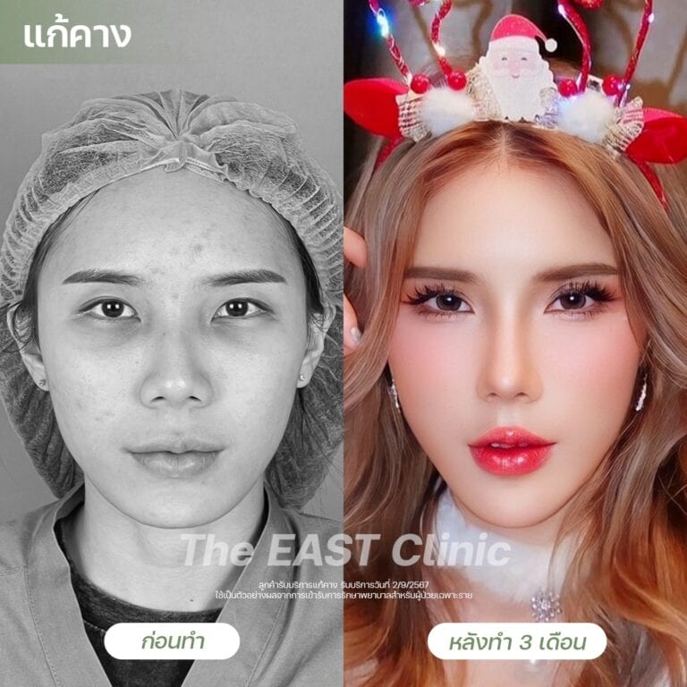 chin-surgery
