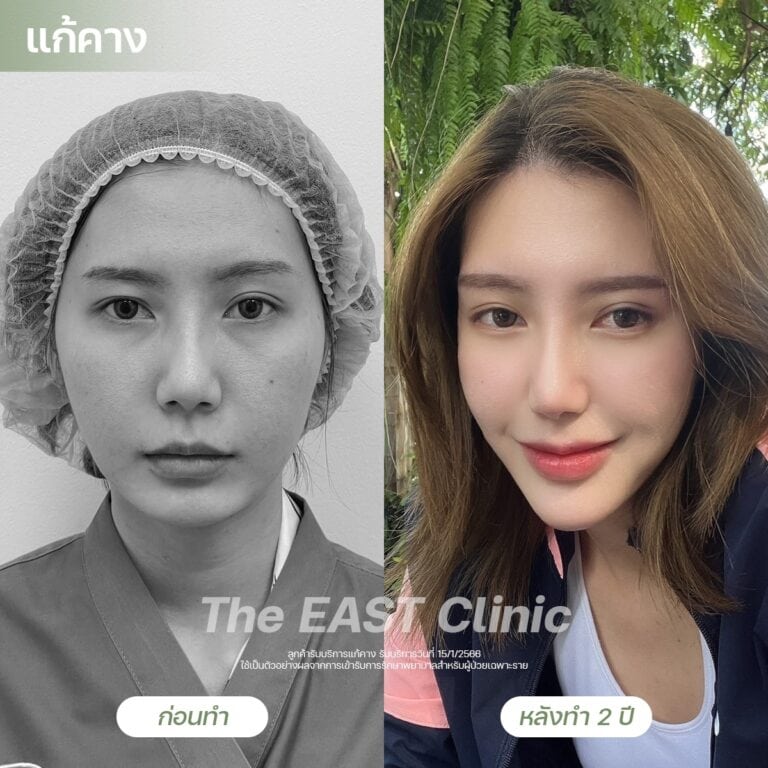 chin-surgery