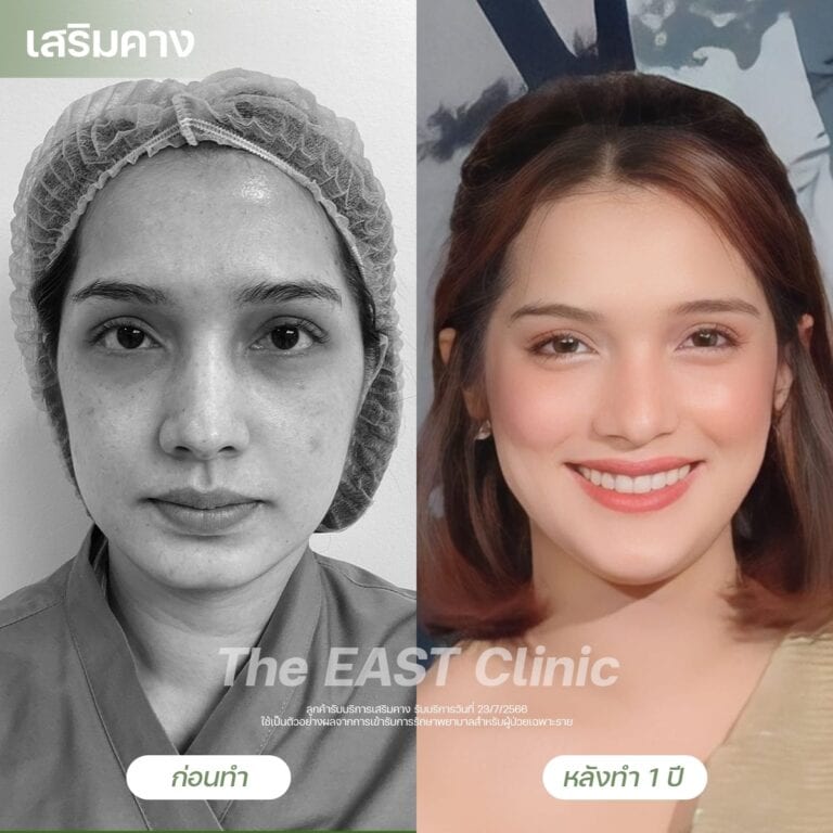 chin-surgery