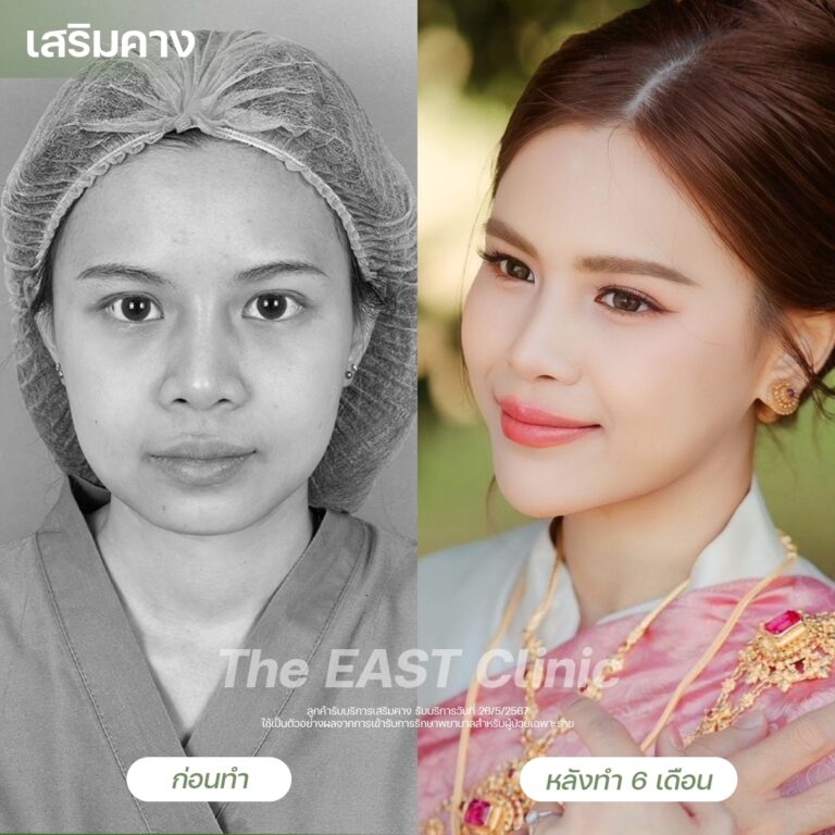 chin-surgery