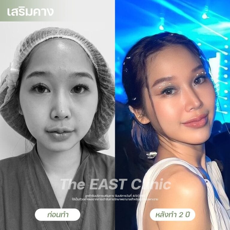 chin-surgery