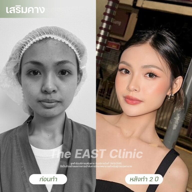 chin-surgery