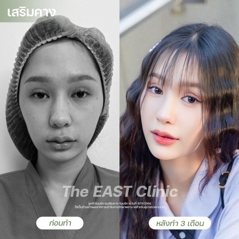 chin-surgery