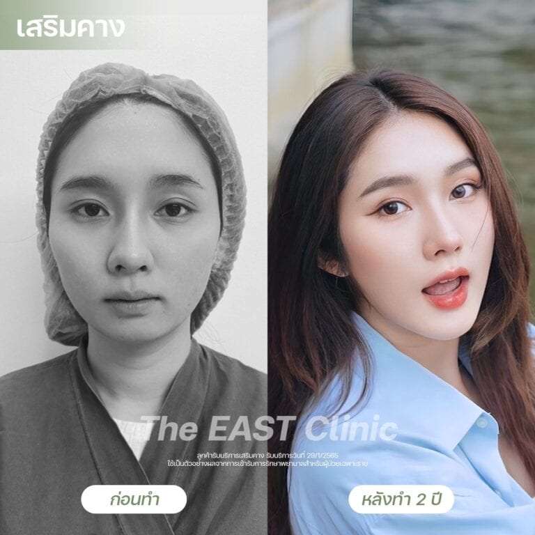 chin-surgery