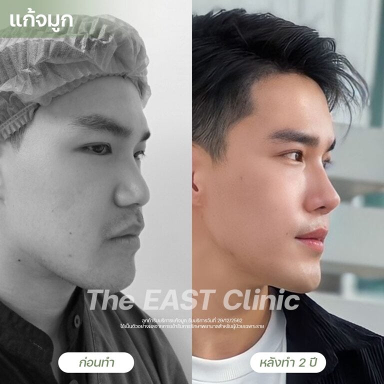 nose-surgery