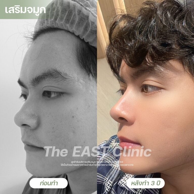 nose-surgery