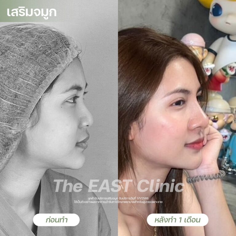 nose-surgery