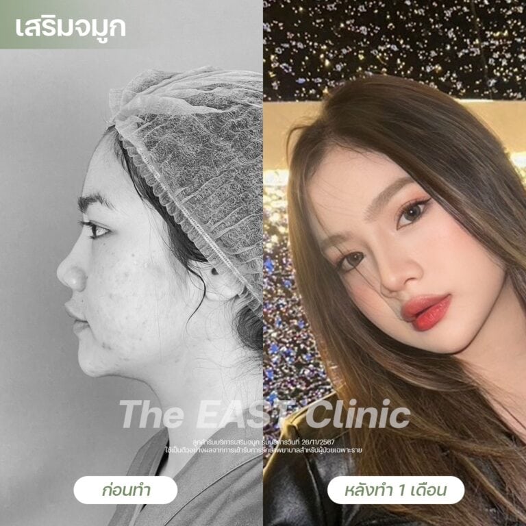 nose-surgery