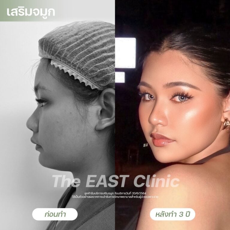 nose-surgery