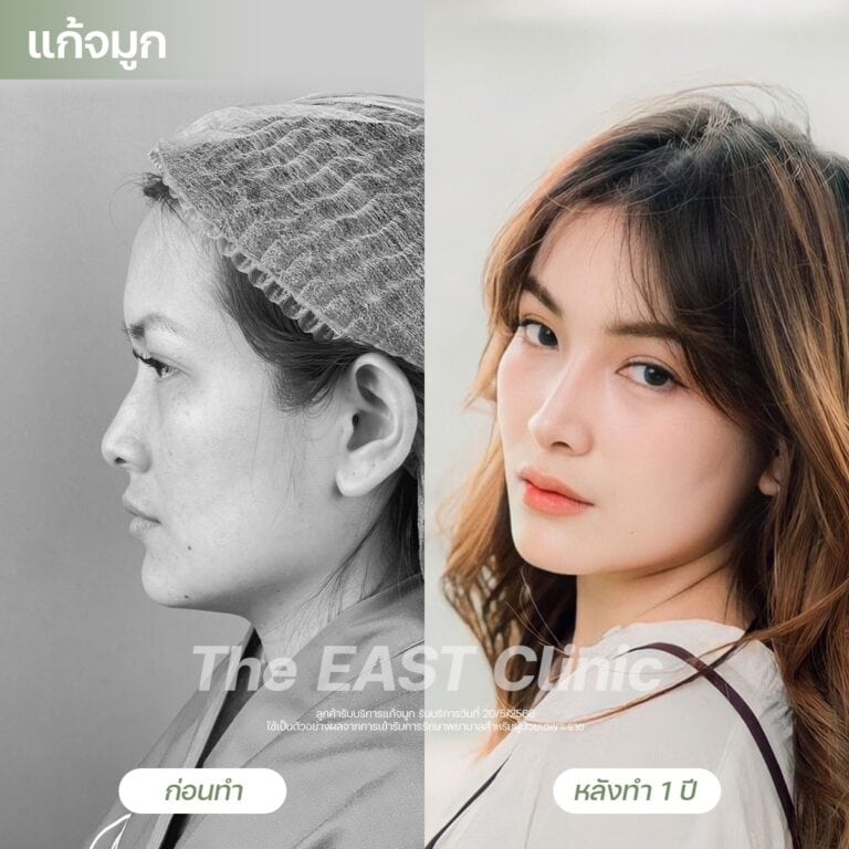nose-surgery