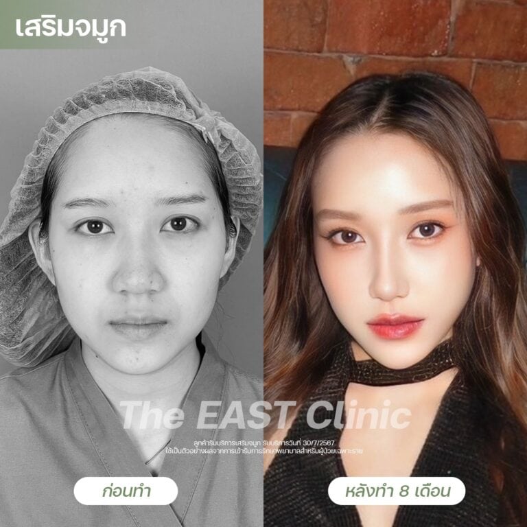 nose-surgery