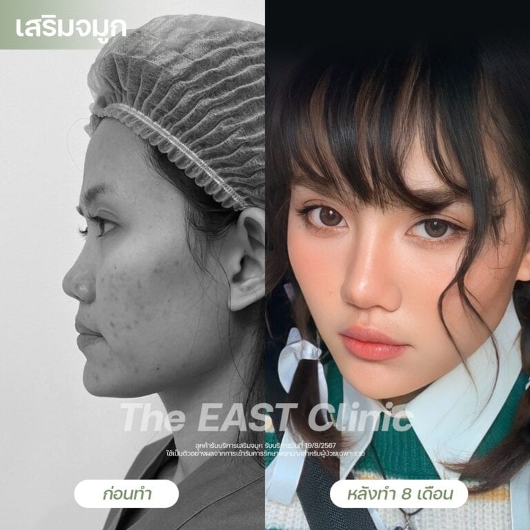nose-surgery