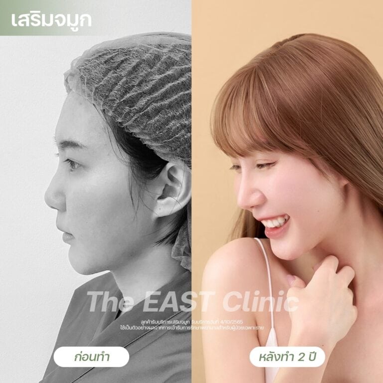 nose-surgery