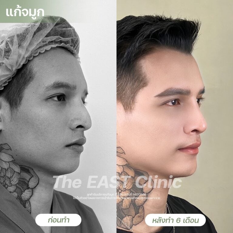 nose-surgery