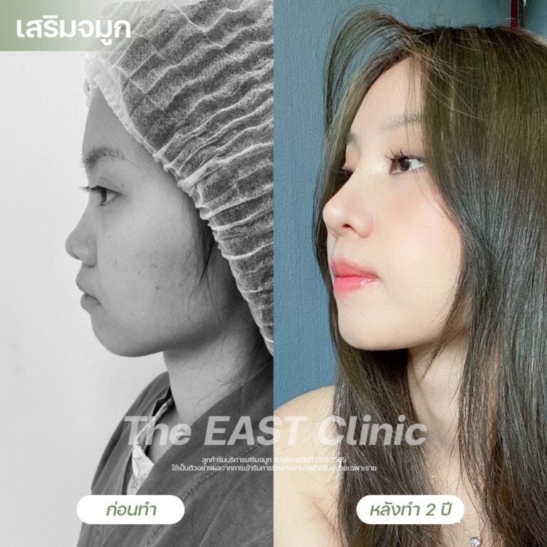 nose-surgery