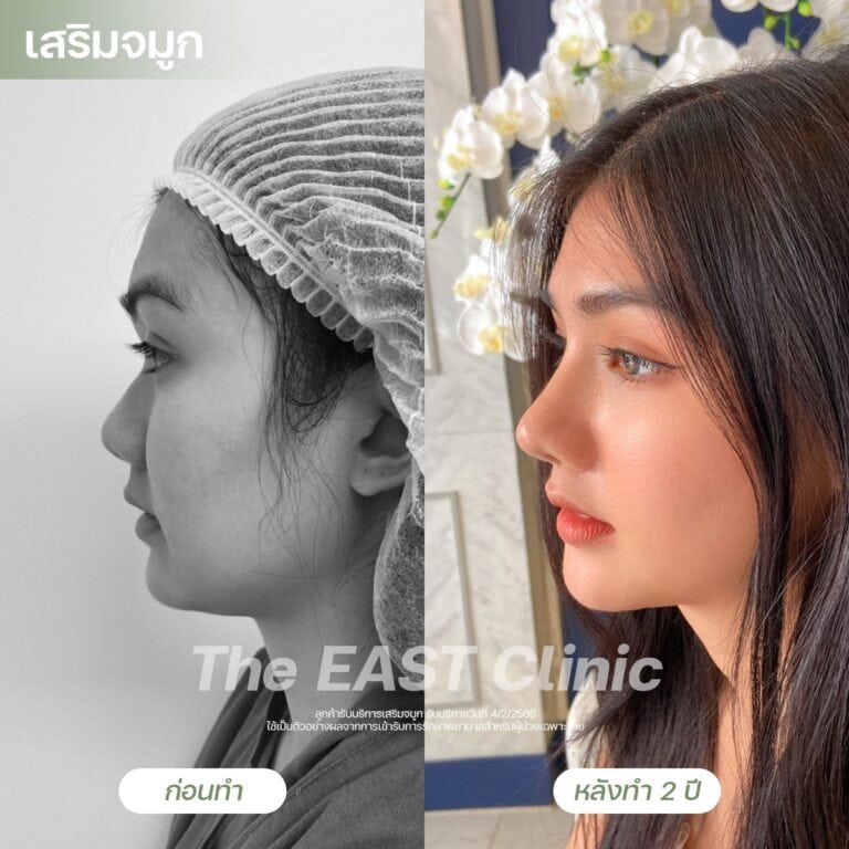 nose-surgery