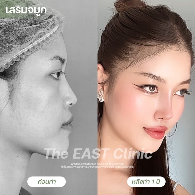 nose-surgery