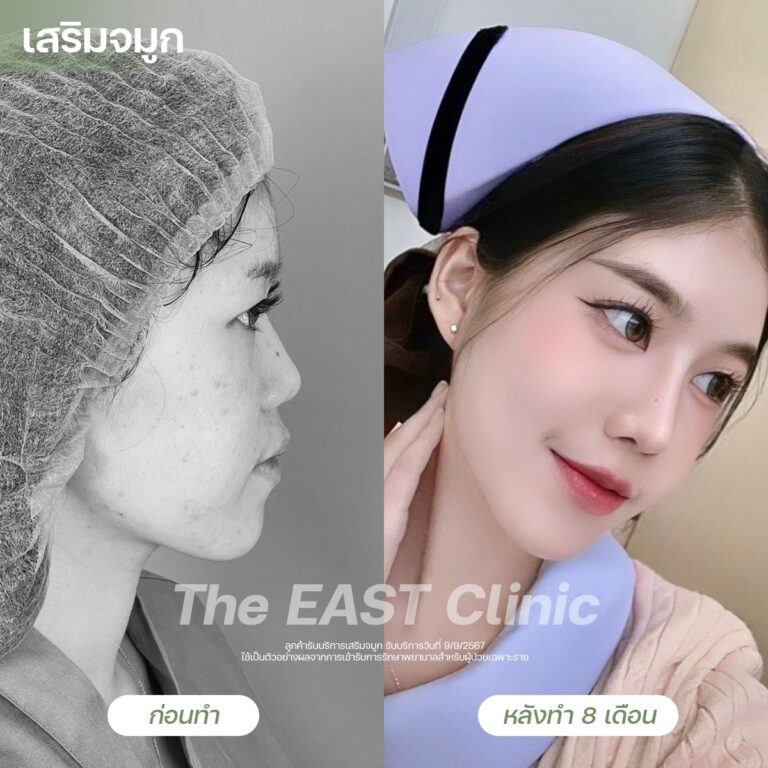 nose-surgery