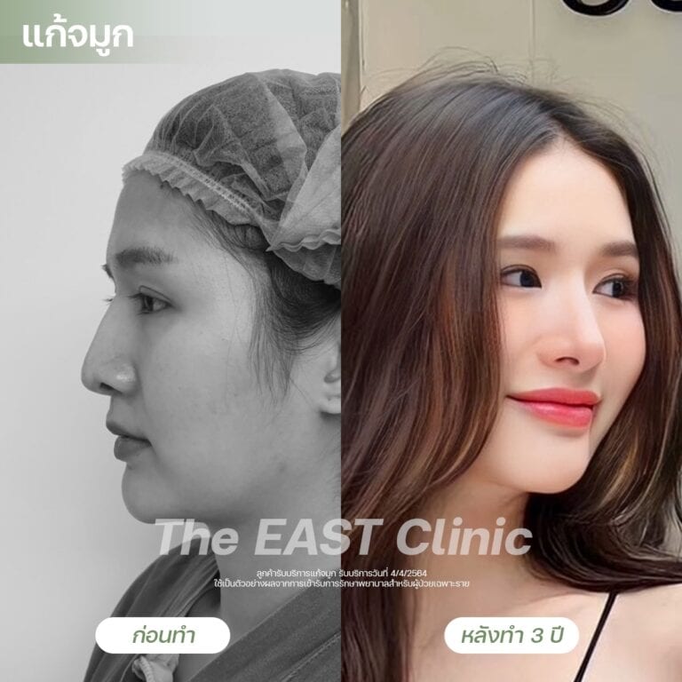 nose-surgery