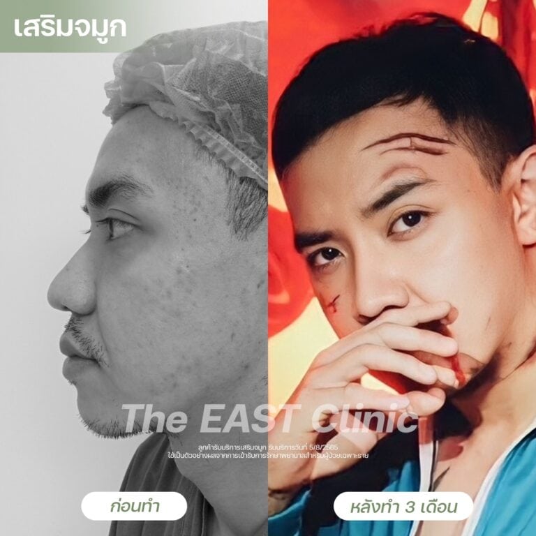 nose-surgery