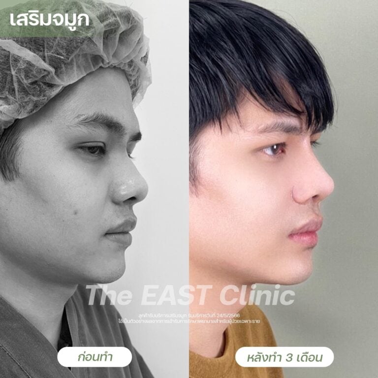 nose-surgery