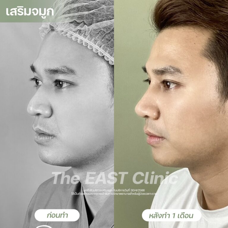 nose-surgery