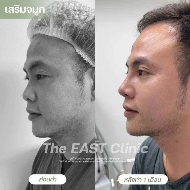 nose-surgery