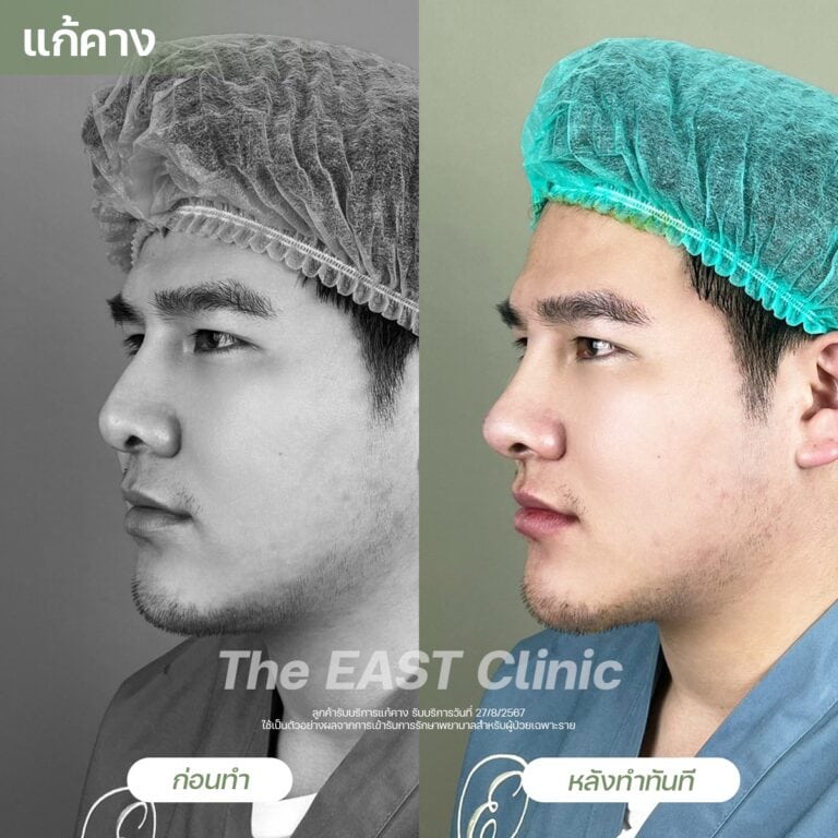 chin-surgery