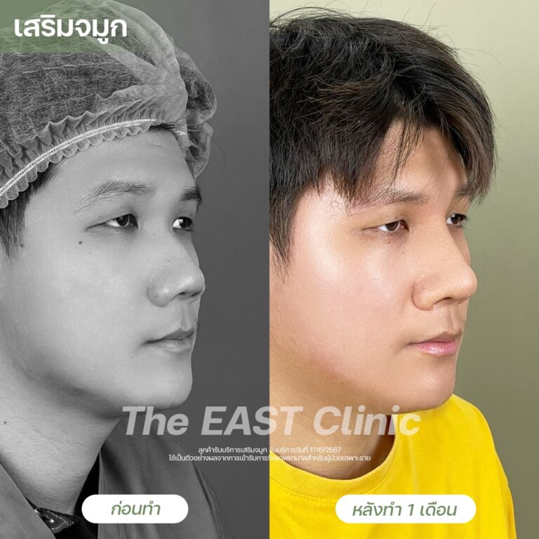 nose-surgery