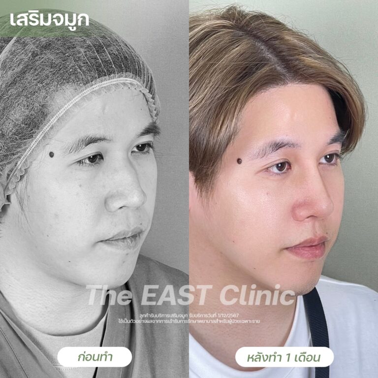 nose-surgery
