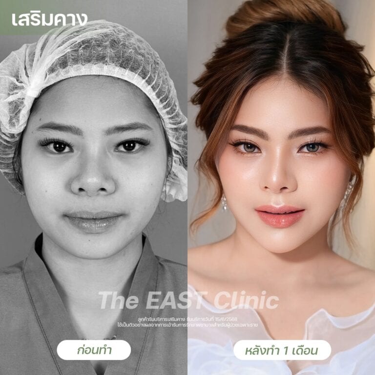 chin-surgery